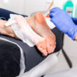 Callus Peel